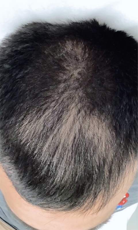 Hair Restoration with PRP Before & After Image