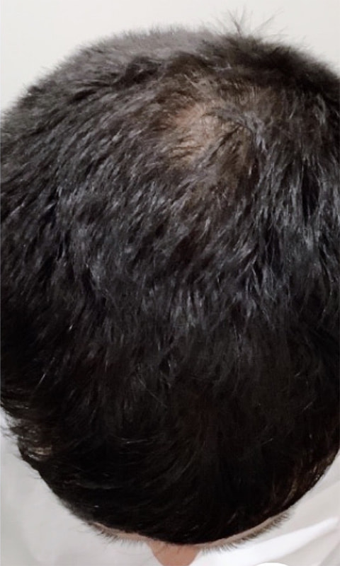 Hair Restoration with PRP Before & After Image