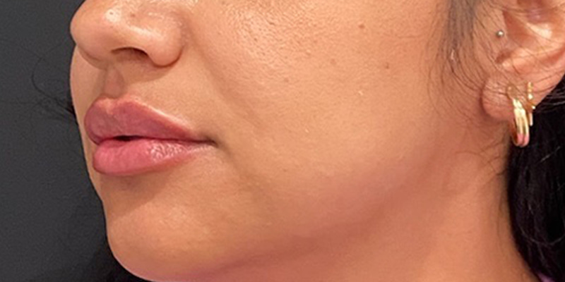 Lip Fillers Before & After Image