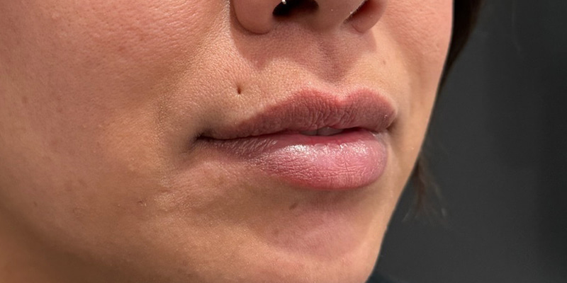 Lip Fillers Before & After Image