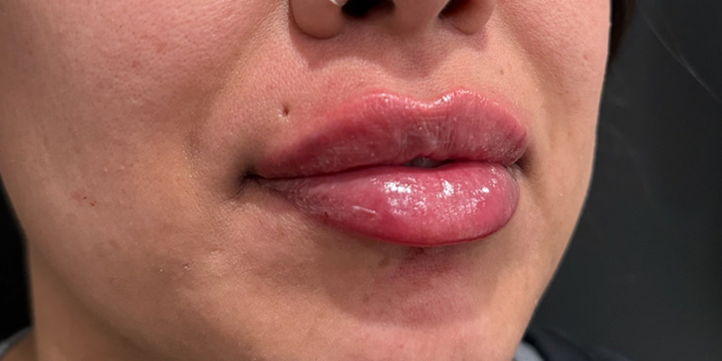 Lip Fillers Before & After Image