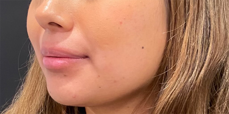 Lip Fillers Before & After Image