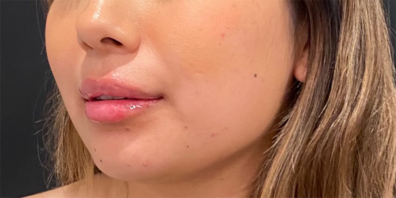 Lip Fillers Before & After Image