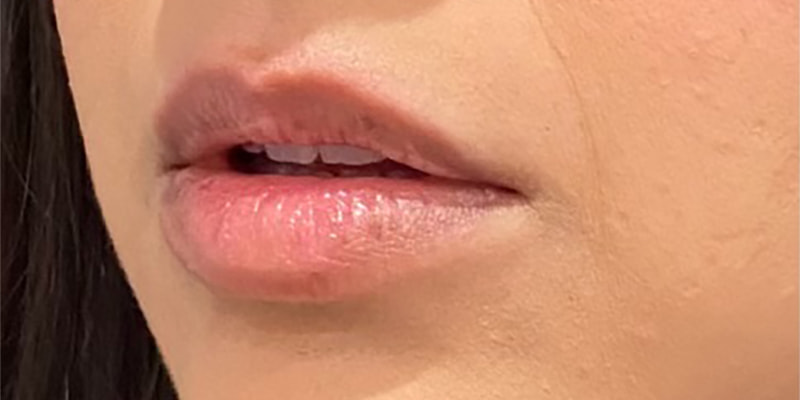 Lip Fillers Before & After Image