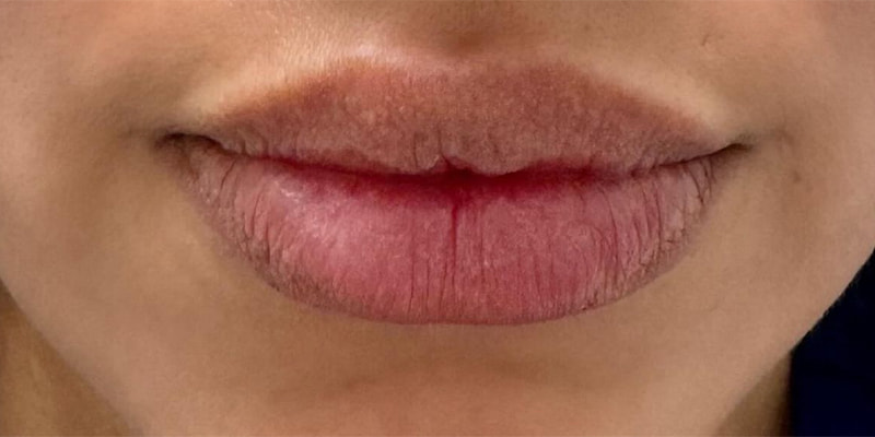 Lip Fillers Before & After Image