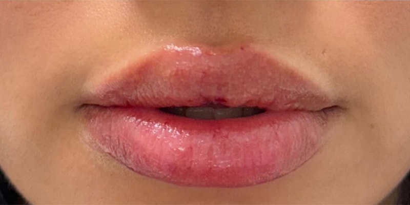 Lip Fillers Before & After Image