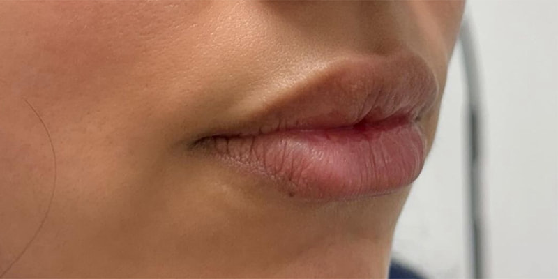 Lip Fillers Before & After Image