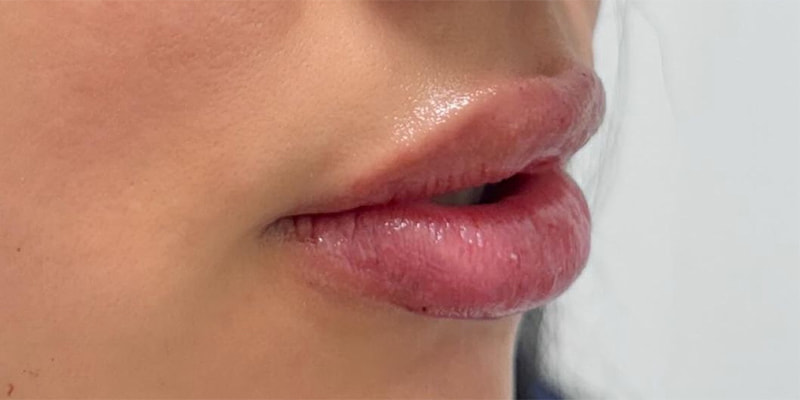 Lip Fillers Before & After Image