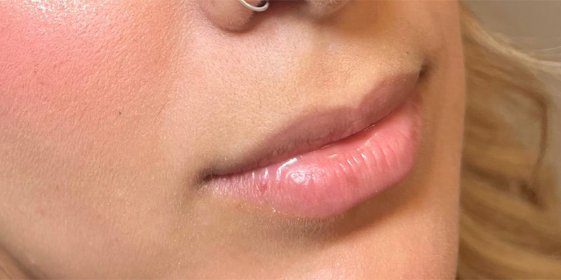 Lip Fillers Before & After Image