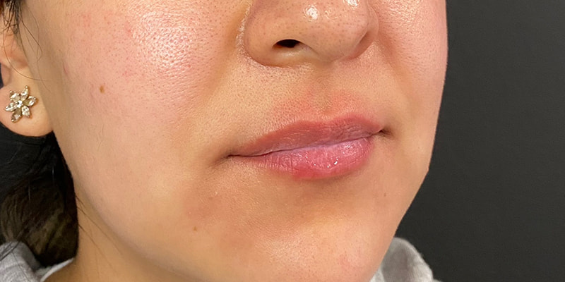 Lip Fillers Before & After Image