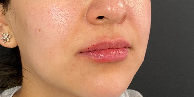 Lip Fillers Before & After Image