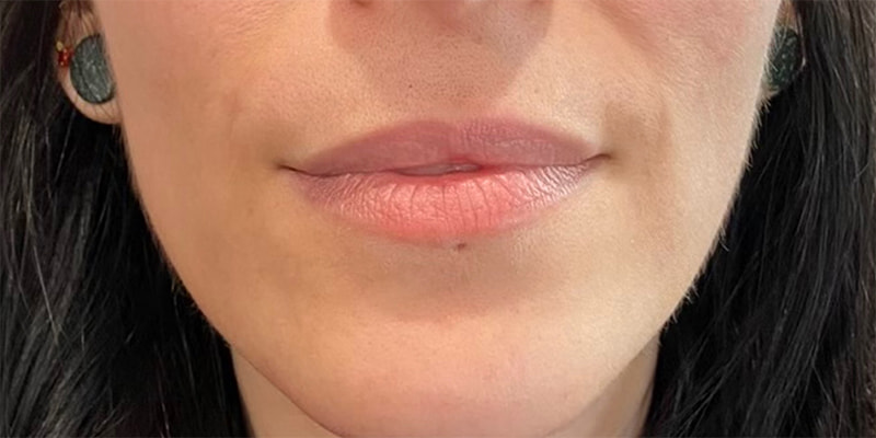 Lip Fillers Before & After Image