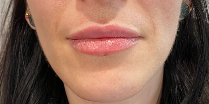 Lip Fillers Before & After Image