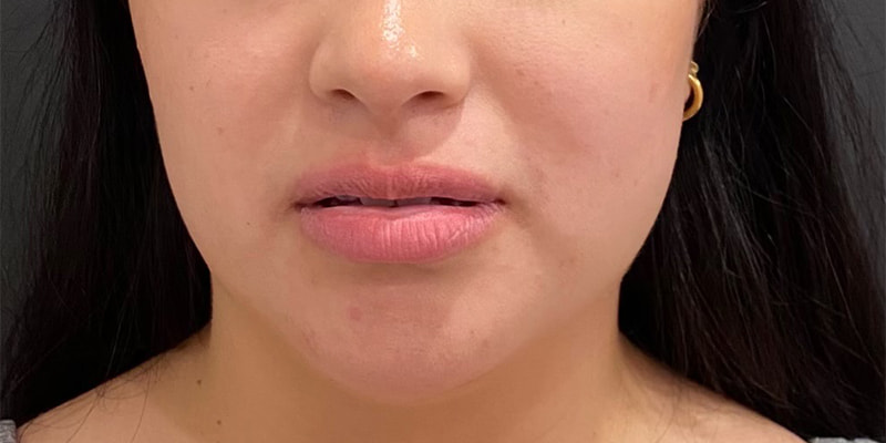 Lip Fillers Before & After Image