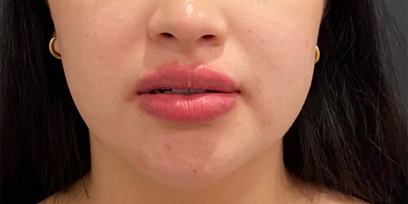 Lip Fillers Before & After Image