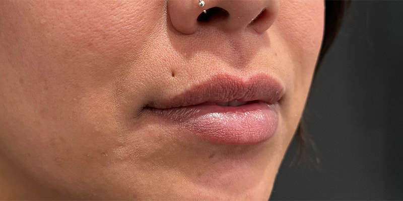 Lip Fillers Before & After Image