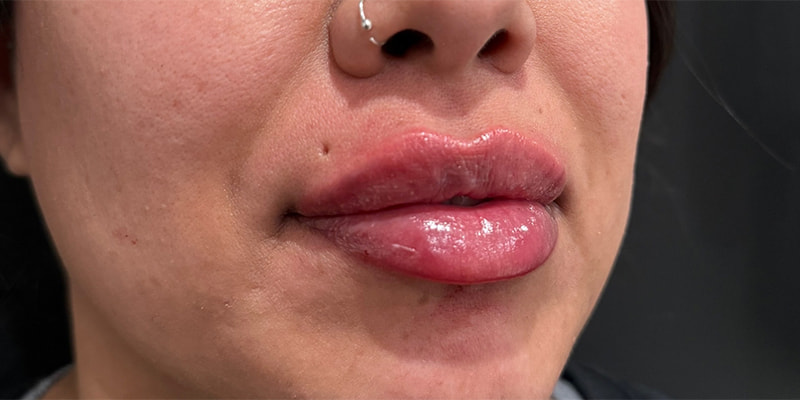 Lip Fillers Before & After Image