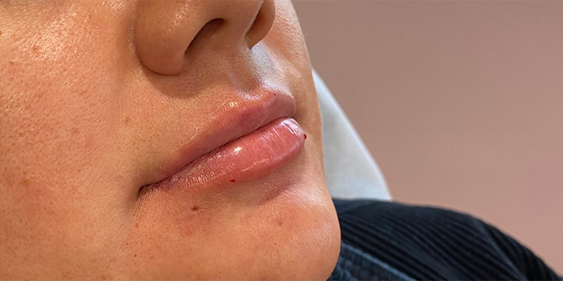 Lip Fillers Before & After Image