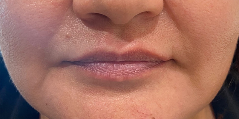 Lip Fillers Before & After Image