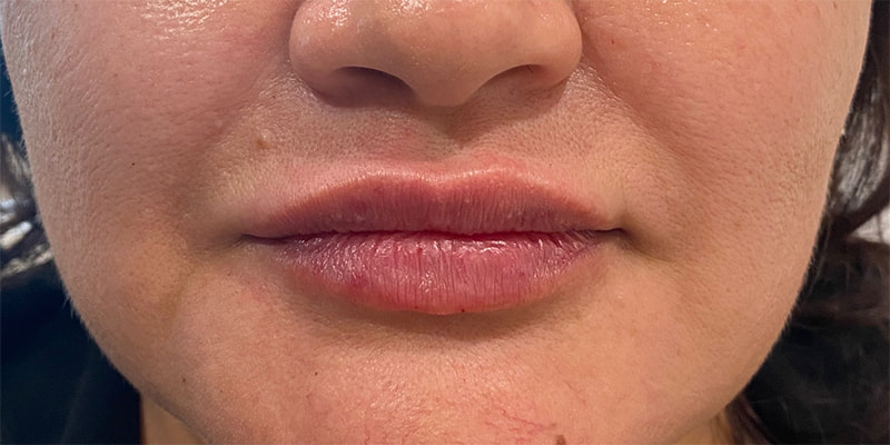 Lip Fillers Before & After Image