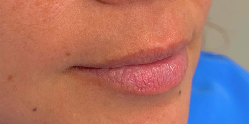 Lip Fillers Before & After Image