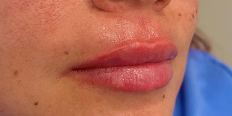 Lip Fillers Before & After Image