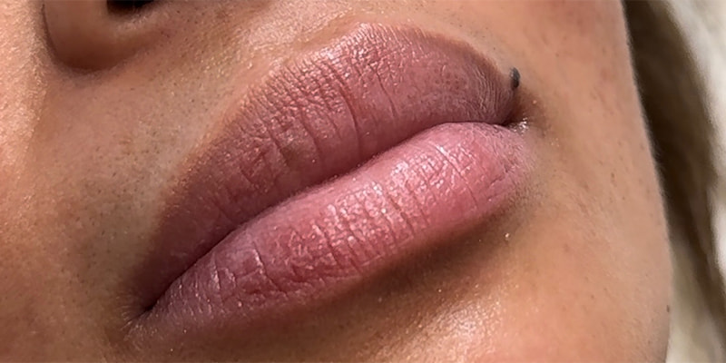 Lip Fillers Before & After Image