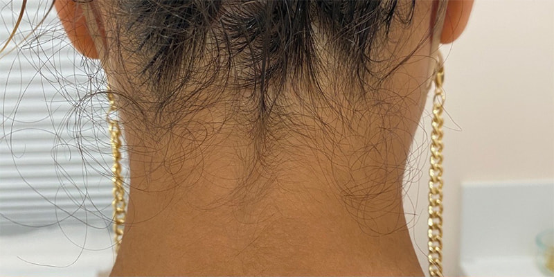 Laser Hair Removal Before & After Image