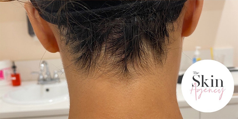 Laser Hair Removal Before & After Image